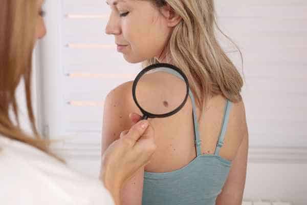 What Are Traditional Skin Lesion Removal Methods Chesterfield?