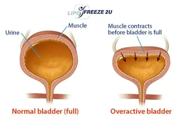 diagram of overactive bladder treatment Chesterfield