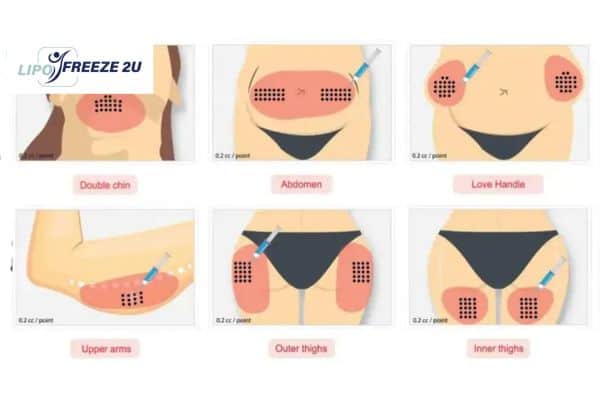Benefits of Choosing Aqualyx for Fat Reduction Chesterfield