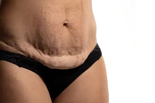 loose skin after weight loss injections Chesterfield
