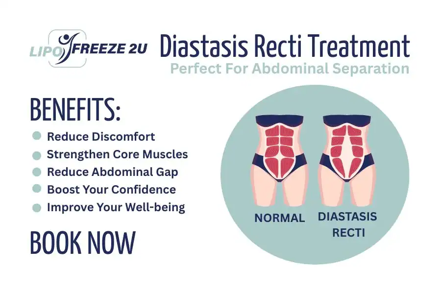 How Long Will It Take to See Improvements in Diastasis Recti Chesterfield