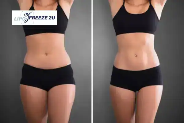 How Can LIPO FREEZE 2U Support Your Post-Pregnancy Body Recovery Chesterfield?