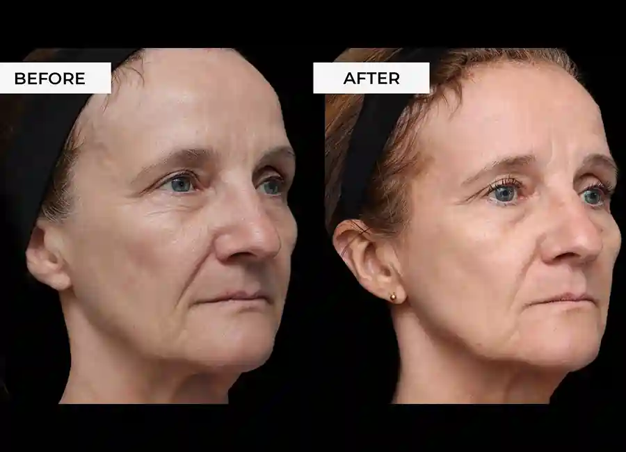 How Many RF Microneedling Sessions Will You Need to See a Difference Chesterfield?