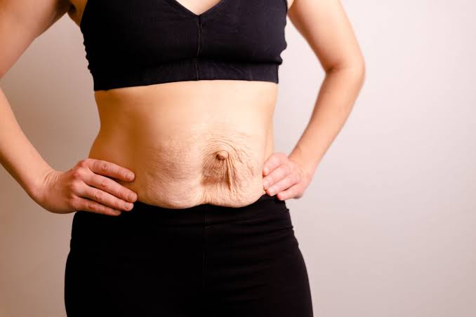 Is Surgery Really the Only Way to Repair Diastasis Recti Chesterfield?