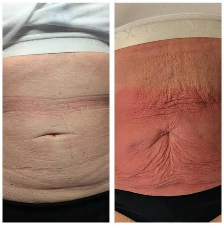 How Does RF Microneedling Improve Crepey, Thin and Uneven Skin Texture Chesterfield?