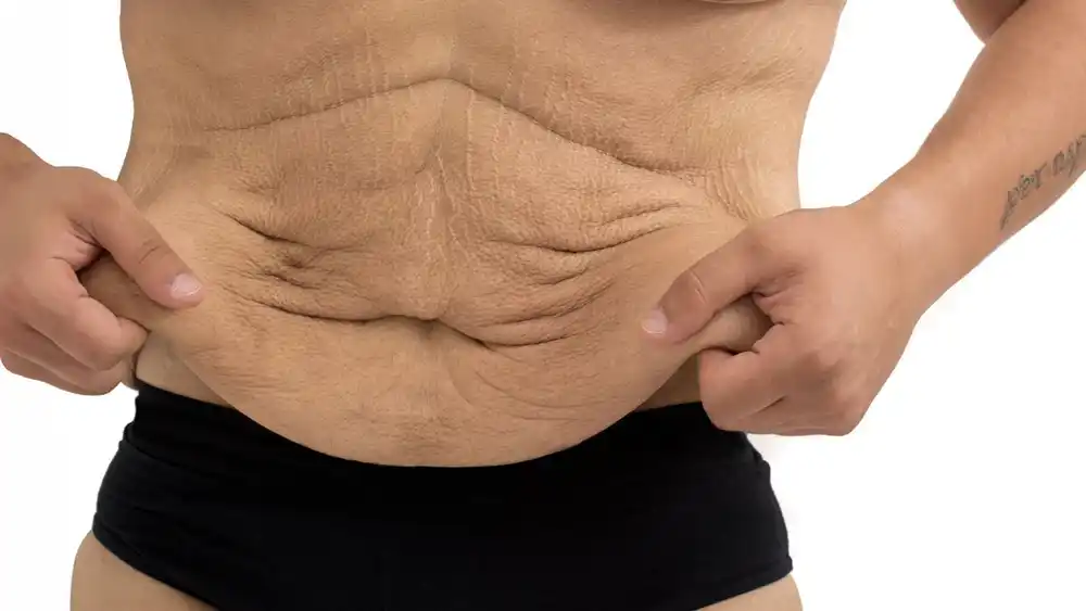 Why Does Weight Loss Medication Leave Some People With Loose or Sagging Skin Chesterfield?